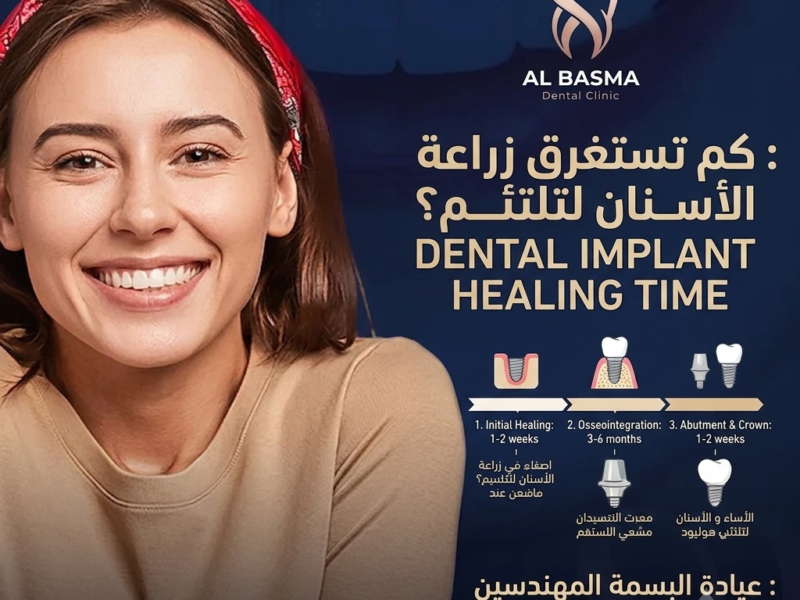 كم تستغرق زراعة الأسنان لتلتئم؟ | عيادة البسمة المهندسين